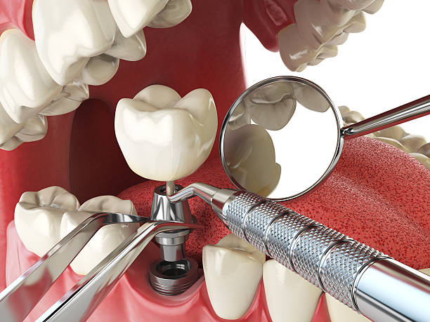 Best Broken or Cracked Tooth Emergency Dentist in Marshall, MI